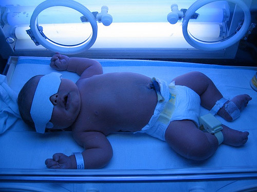 Chủ quan với bệnh vàng da có thể dẫn đến bại não ở trẻ sơ sinh
