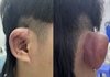 Hiểm hoạ từ xỏ khuyên trên vành tai